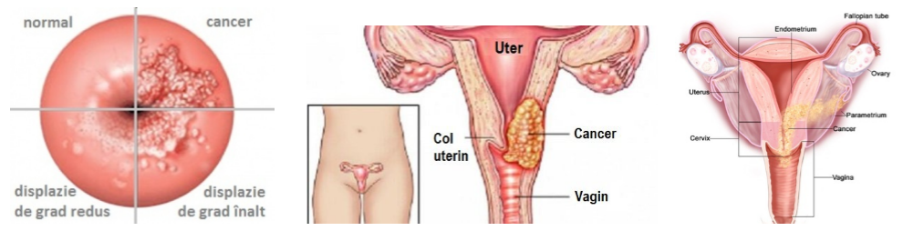 virusul papilloma cancer de col uterin